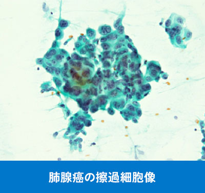 肺腺癌の擦過細胞像